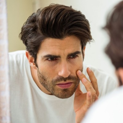 HOW TO GET RID OF GREASY SKIN